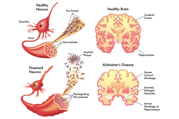 Alzheimer’s Disease treatment in bangalore india with dr rao best doctor