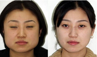 botox filler treatment doctor in bangalore india